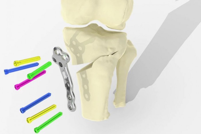 [圖]關節炎患者福音：利用3D列印讓膝關節手術更好更快